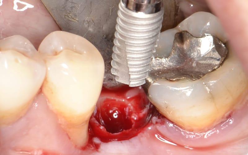 Full immersion in Chirurgia Orale e Implantare: Nuovi Paradigmi