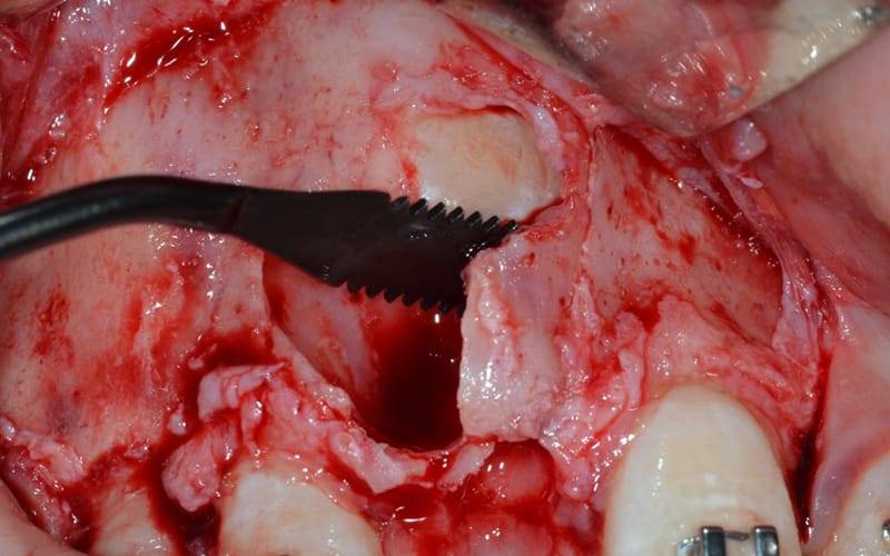 Chirurgia Piezoelettrica: Indicazioni E Limiti In Odontoiatria