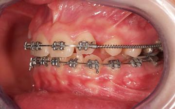 Ortodonzia Neuromuscolare: Il Trattamento Ortodontico Gnatologico