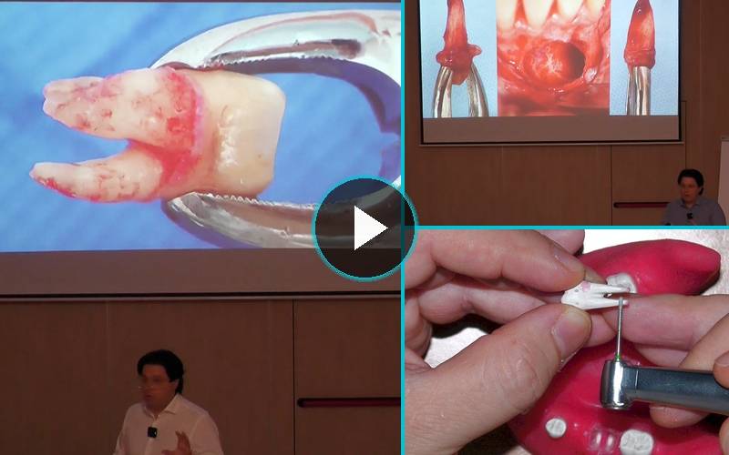 Le Trasposizioni Dentarie: Autotrapianti e Reimpianti