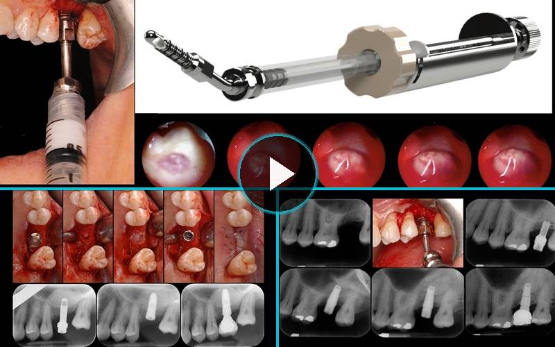 Il rialzo del pavimento del seno mascellare per via crestale: quando la semplicità incontra la predicibilità