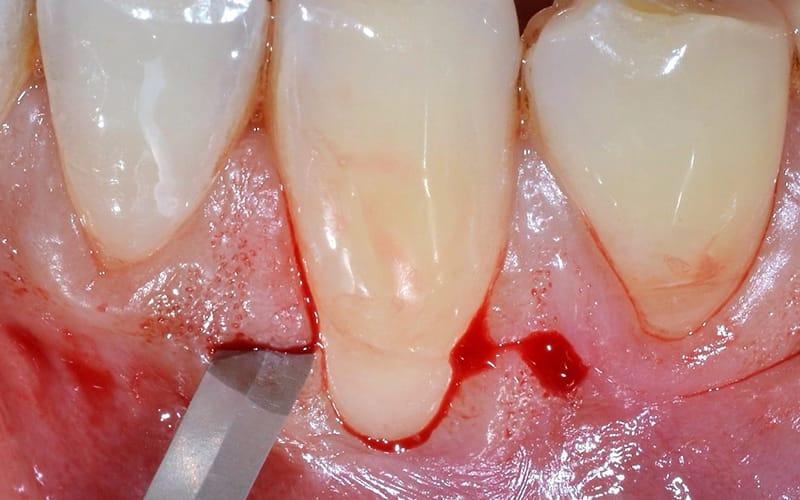 Full Immersion In Chirurgia Plastica Parodontale, Periimplantiti e Gestione dei Tessuti Molli Periimplantari (Livello Avanzato)