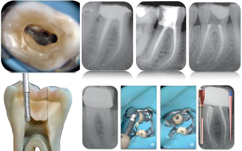 Endodonzia Masterclass 1 Full Immersion