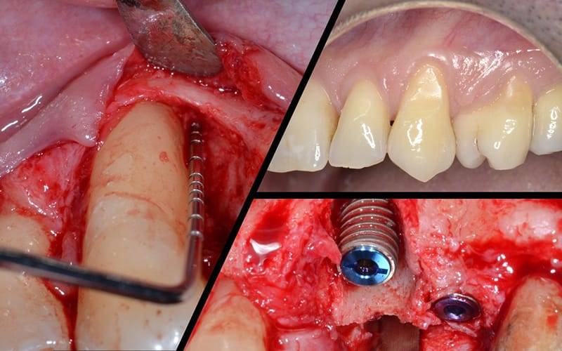 Gestione Dei Tessuti Intorno A Denti Naturali E Impianti: Razionale Biologico E Protocolli Clinici