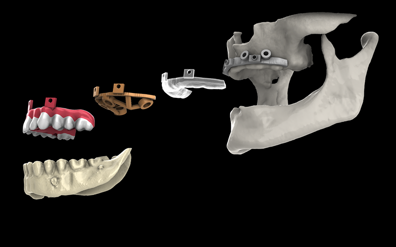 Uso di Software 3D Gratuiti Per La Realizzazione di Dime Chirurgiche Scomponibili Per Chirurgia Implantare Full Arch